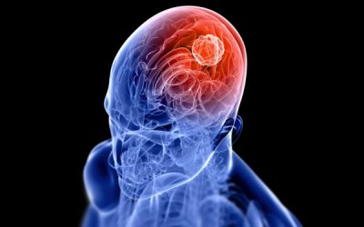 Emorragie cerebrali – EMOREC